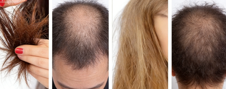 Rosemary Leaf Extract For Hair Rosemary Leaf Extract For Hair